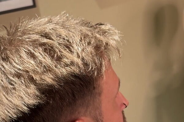 Haarsystem für Männer: natürlich wirkendes Deckhaar in Seitenansicht